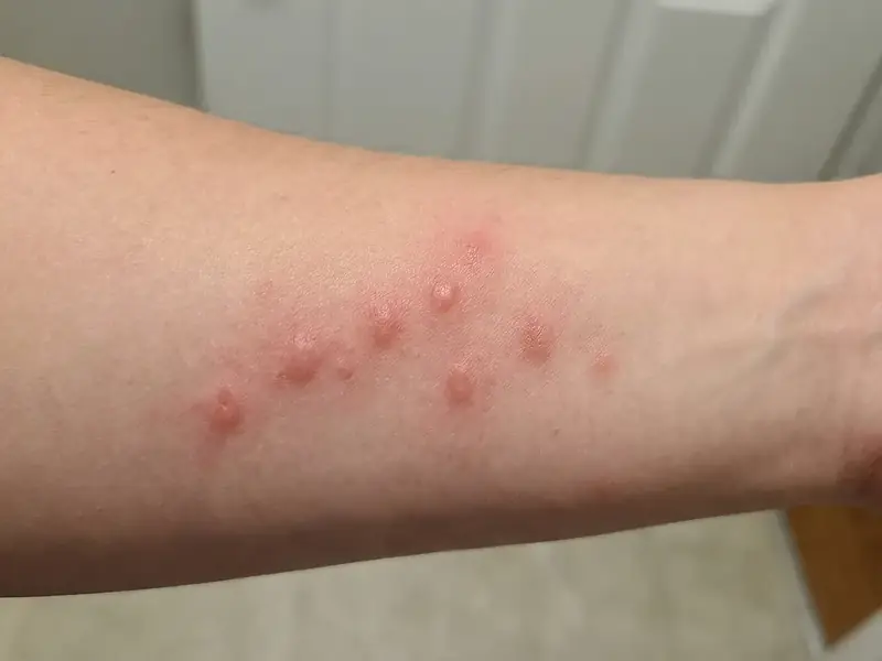 Close-up of a forearm with multiple red bed bug bite welts